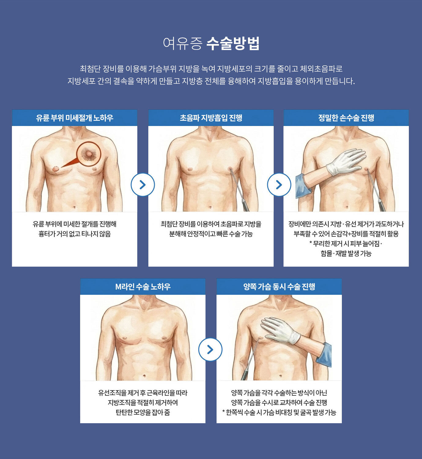 여유증 수술 방법
