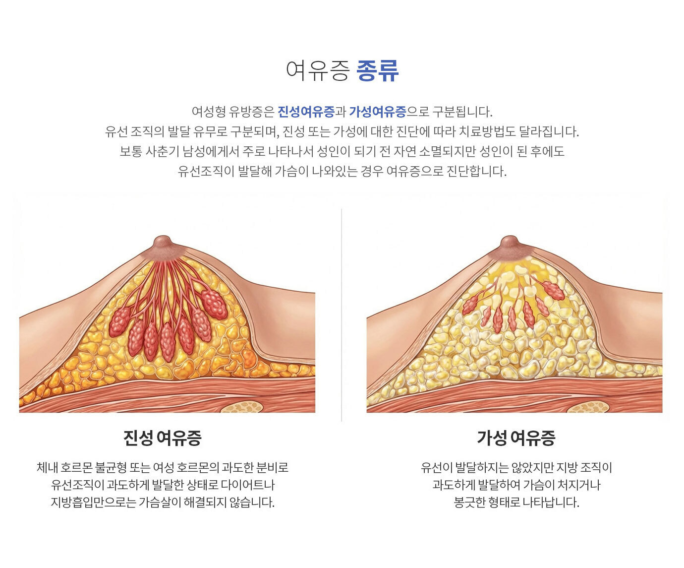 여유증 진단과 수술방법