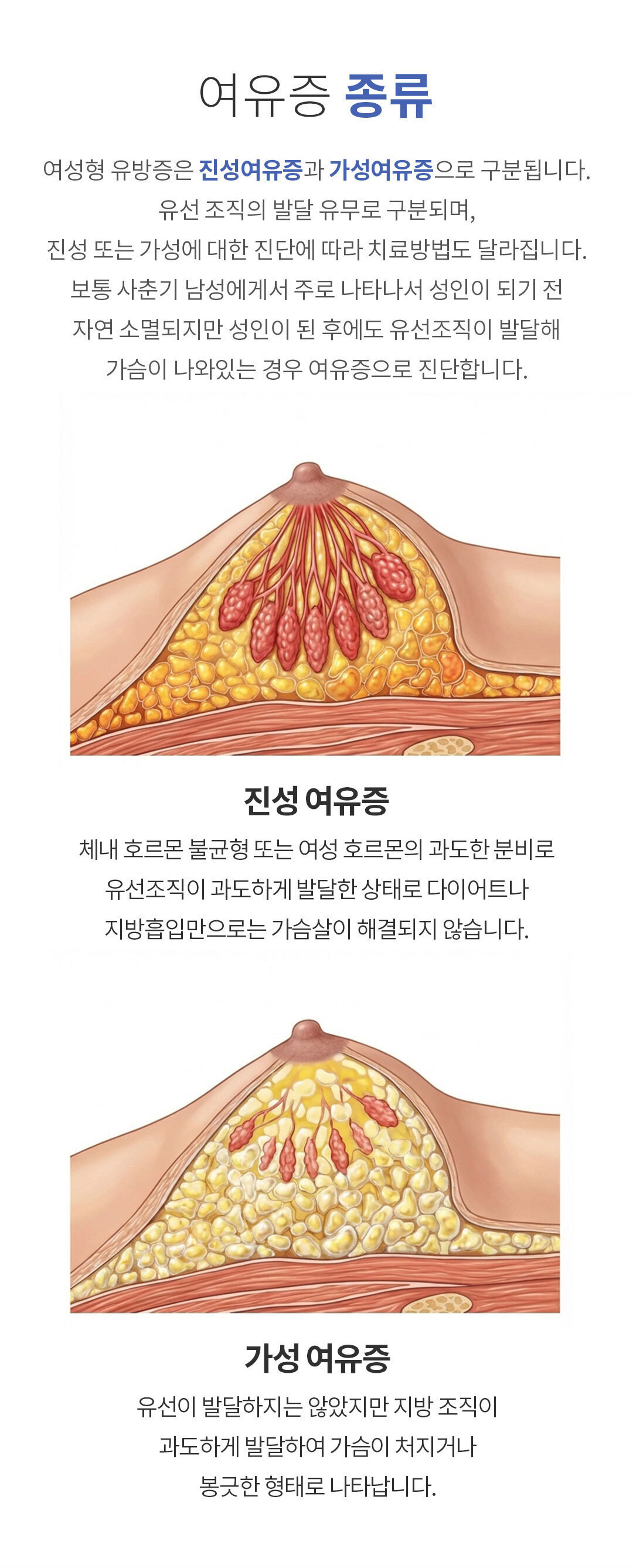 여유증 진단과 수술방법