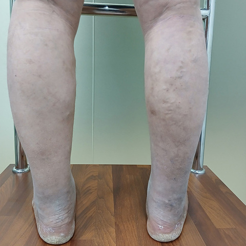 [재발한 하지정맥류로 하이브리드 수술 시행 (중증 하지정맥류 환자)] 50대 남성 12년전 타병원에서 하지정맥류 수술 후 재발, 양측 종아리 팽만감, 피부변색, 중증 다리부종 , 야간다리경련 호소