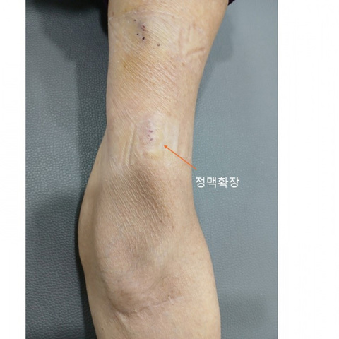 투석혈관조성술 경과 (팔꿈치)