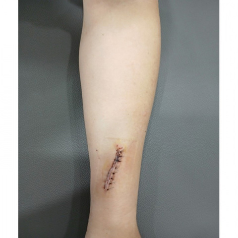 투석혈관조성술 경과 (손목)