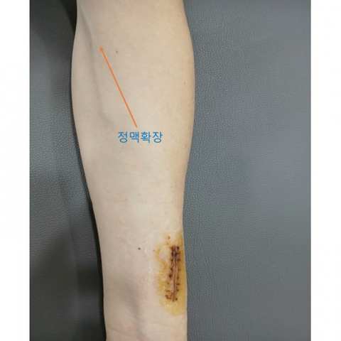 투석혈관조성술 경과 (손목)