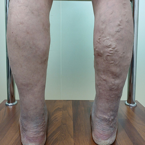 [재발한 하지정맥류로 하이브리드 수술 시행 (중증 하지정맥류 환자)] 50대 남성 12년전 타병원에서 하지정맥류 수술 후 재발, 양측 종아리 팽만감, 피부변색, 중증 다리부종 , 야간다리경련 호소